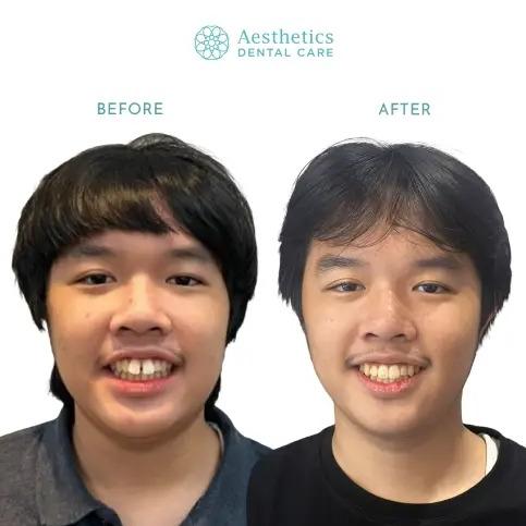 Rahang Bawah Maju (Underbite)