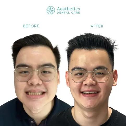 Rahang Bawah Maju (Underbite)