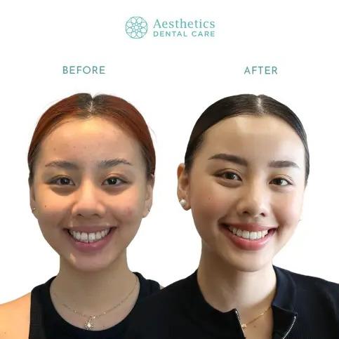 Rahang Bawah Maju (Underbite)