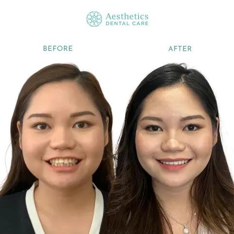 Rahang Bawah Maju (Underbite)