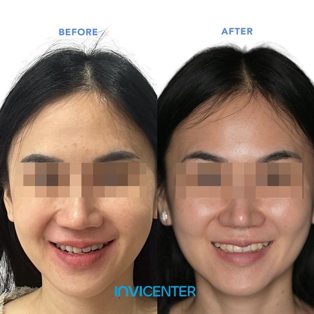 Koreksi Gigitan Terbalik (Underbite)