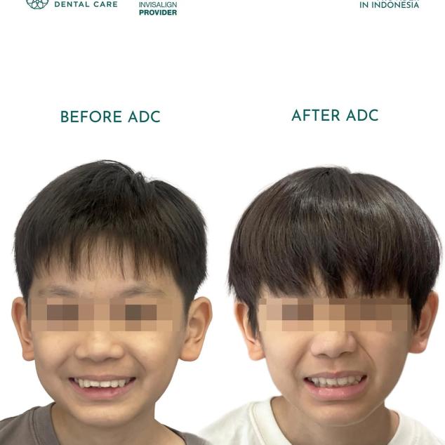 Intervensi Ortodonti Anak (Invisalign First) & Remaja (Invisalign Teen)